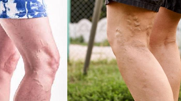 Varicose Veins Cause Heart Attack