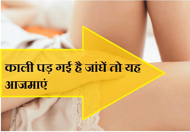 रगड़ खाकर काली पड़ गई हैं जांघें, इन उपायों से एकदम ...