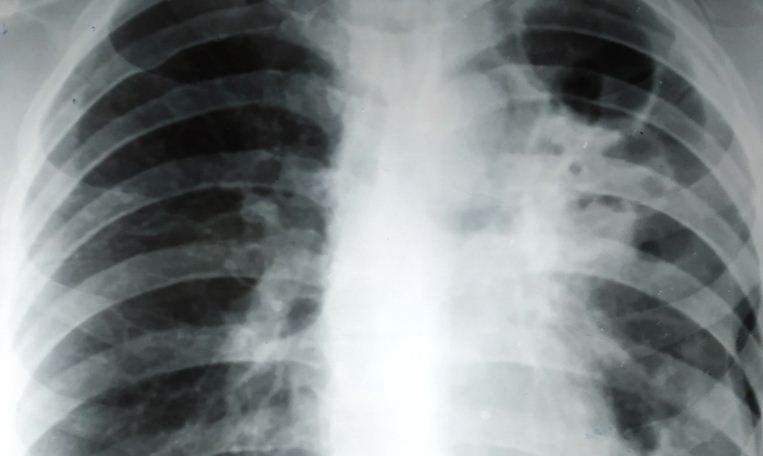 Tuberculosis