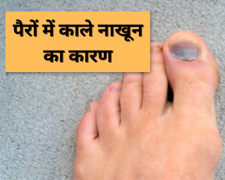 हाथ के नाखून काले पड़ने के लक्षण, कारण, इलाज, दवा, उपचार, डॉक्टर, बचाव -  Melanonychia (Black nails) symptoms, causes, treatment, doctor, medicine,  prevention in Hindi