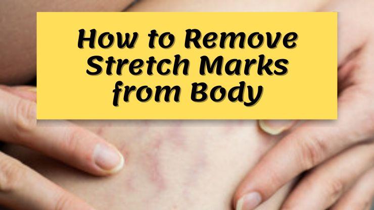 stretch-marks-how-to-remove