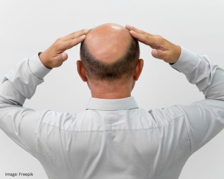Baldness In Men Causes
