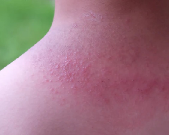 Heat Rash, Kerala Weather, Heat in Kerala, Remedies For Heat Rash