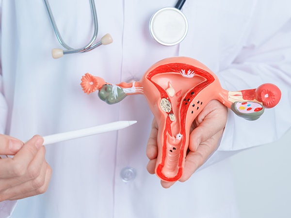 Endometriosis and PCOS