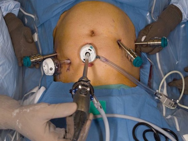 Gynecological surgeries through Robotic technique