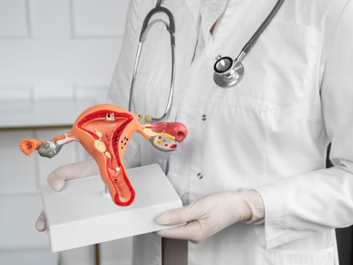 PCOD, PCOD Symptoms, What is PCOD, PCOD in Women, പിസിഒഡി, പിസിഒഡി സ്ത്രീകളില്‍, എന്താണ് പിസിഒഡി