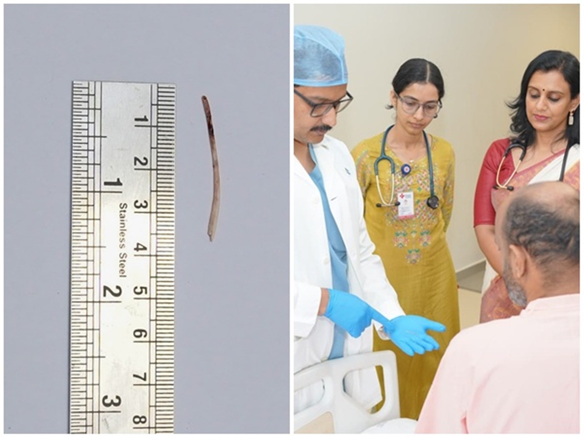 Surgery, Fish bone from throat, Kochi news, Malayalam news, യുവാവിന്റെ കരളില്‍ മീന്‍ മുളള്