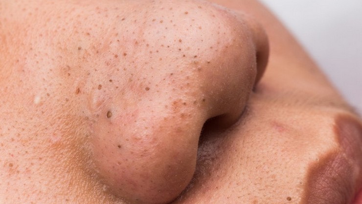 Blackheads