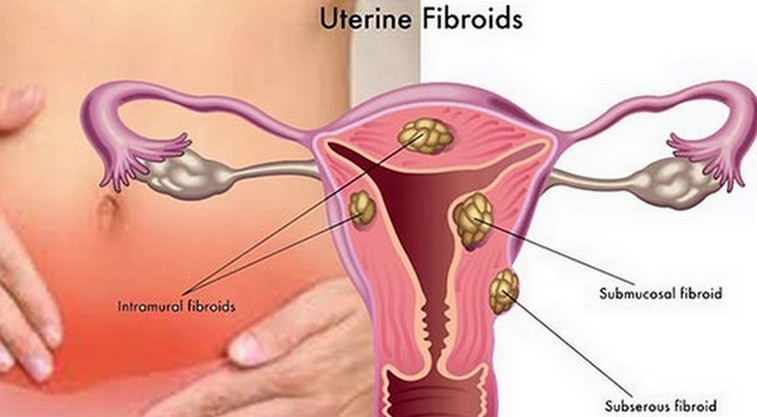 uterus Problem