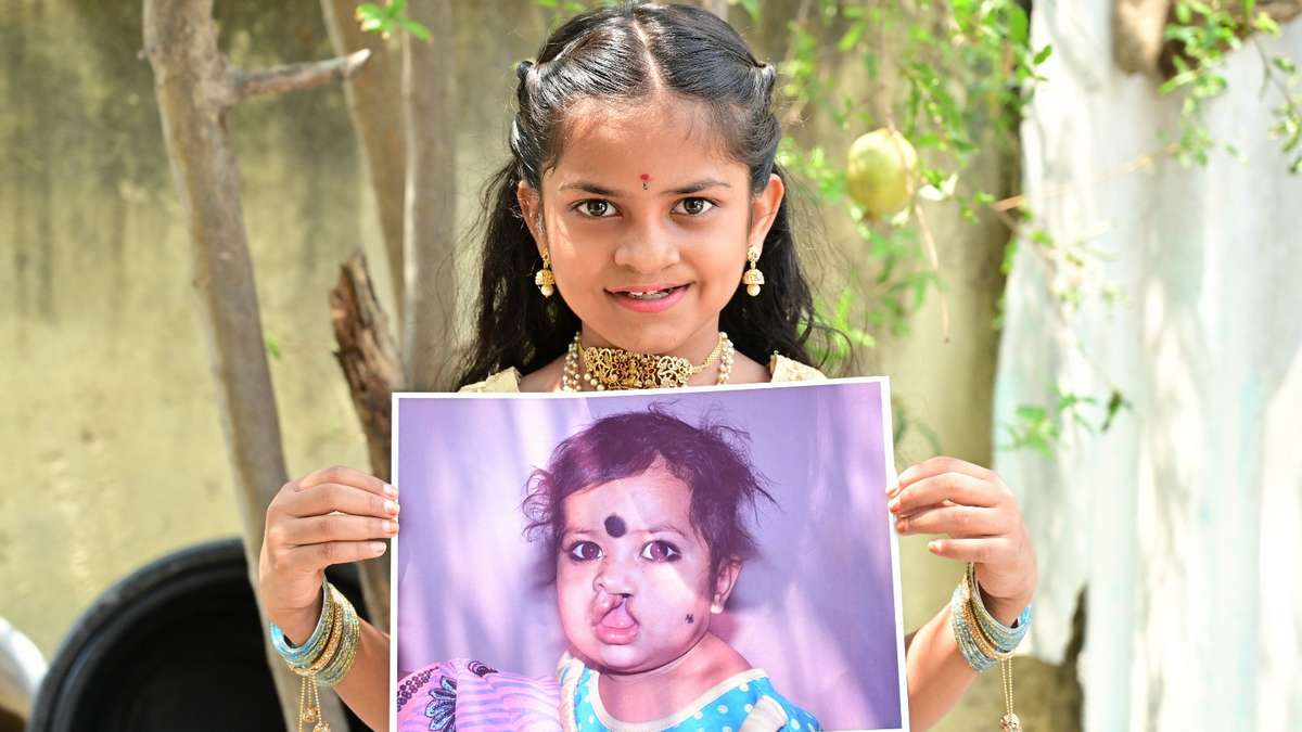 క్లెఫ్ట్స్- గ్రహణం మొర్రి ముందస్తు నిర్ధారణ కోసం ...