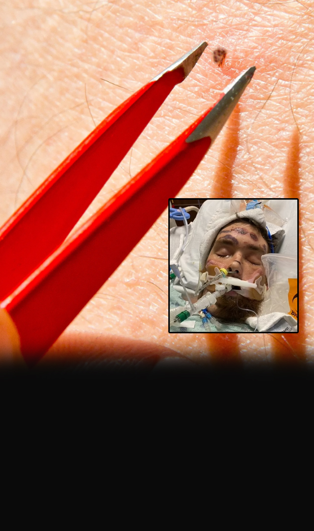 SHOCKING! US man falls into coma after attempting to remove ingrown groin hair