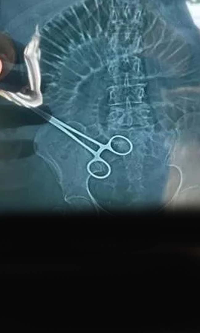 Medical negligence: Bhopal doctor leaves scissors in woman's body during surgery