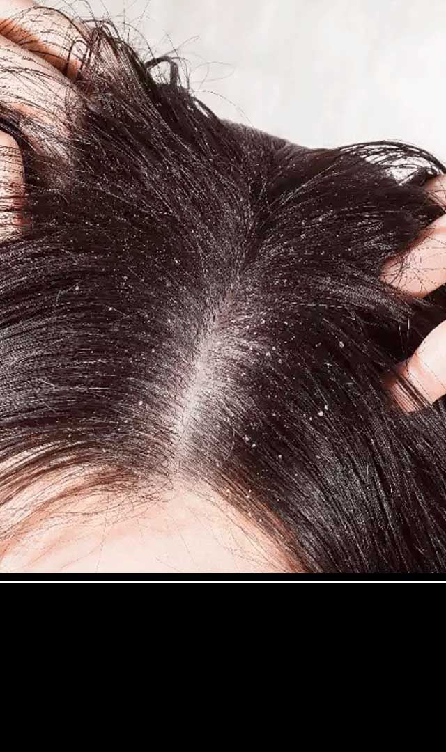 8 ways to get rid of annoying dandruff this winter