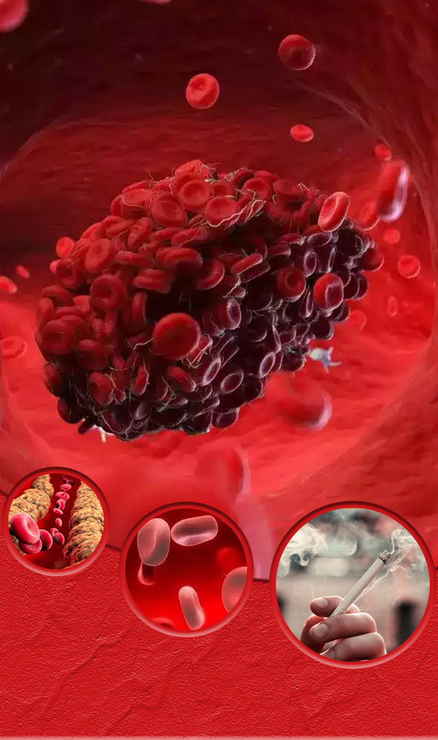  લોહી ગંઠાઈ જવાના કારણો