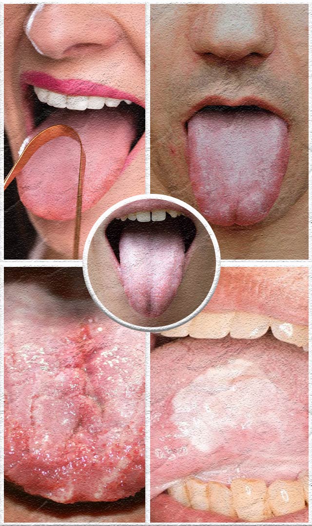  જીભ પર સફેદ પડ જામી જવાના આ છે આ 5 કારણો 