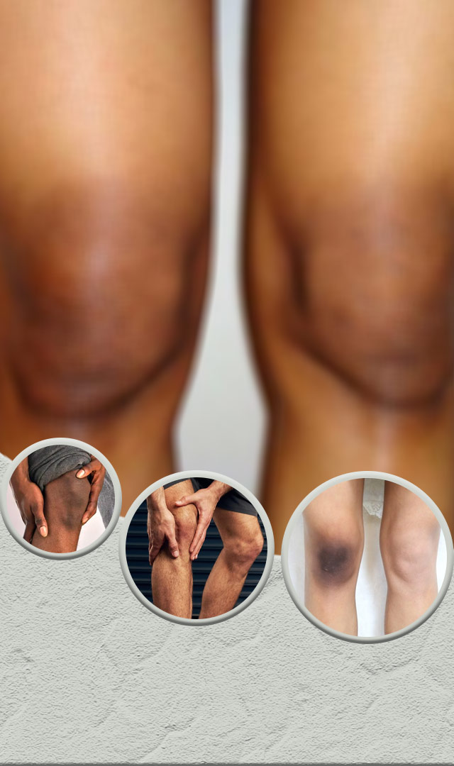  ઘૂંટણની કાળાશ દૂર કરવાના 5 અચૂક ઉપાય 