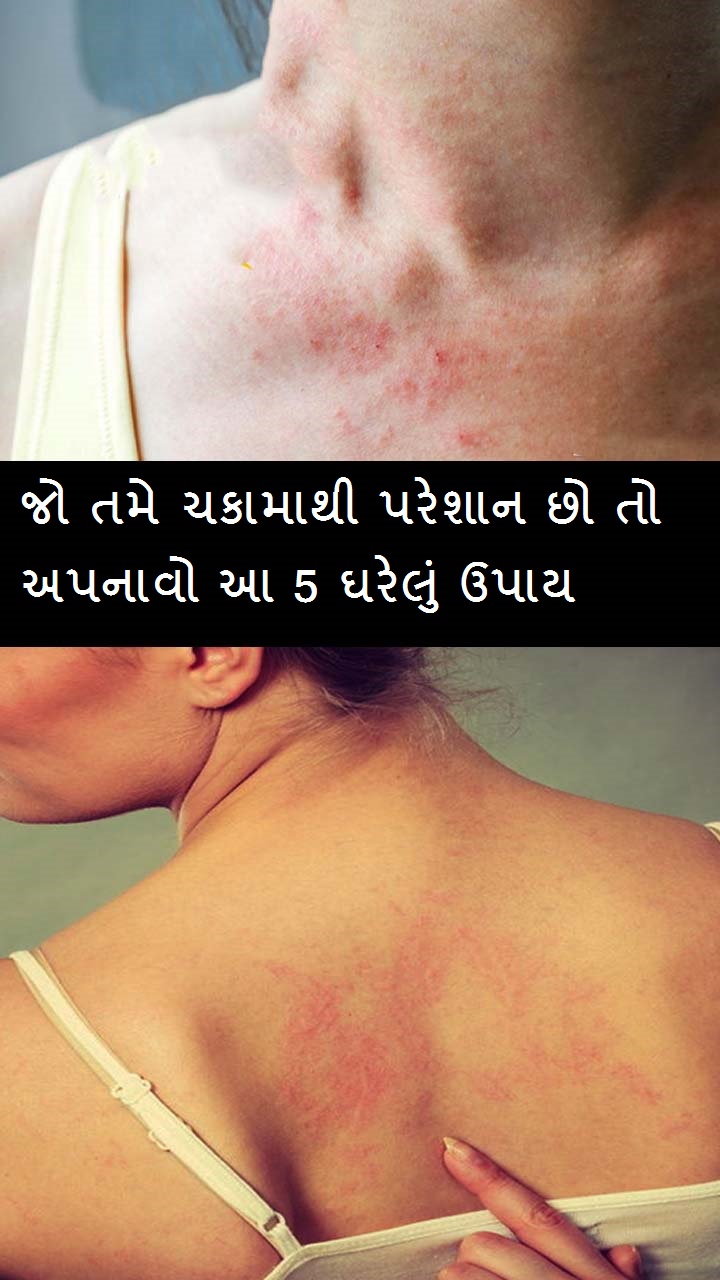  જો તમે ચકામાથી પરેશાન છો તો અપનાવો આ 5 ઘરેલું ઉપાય.