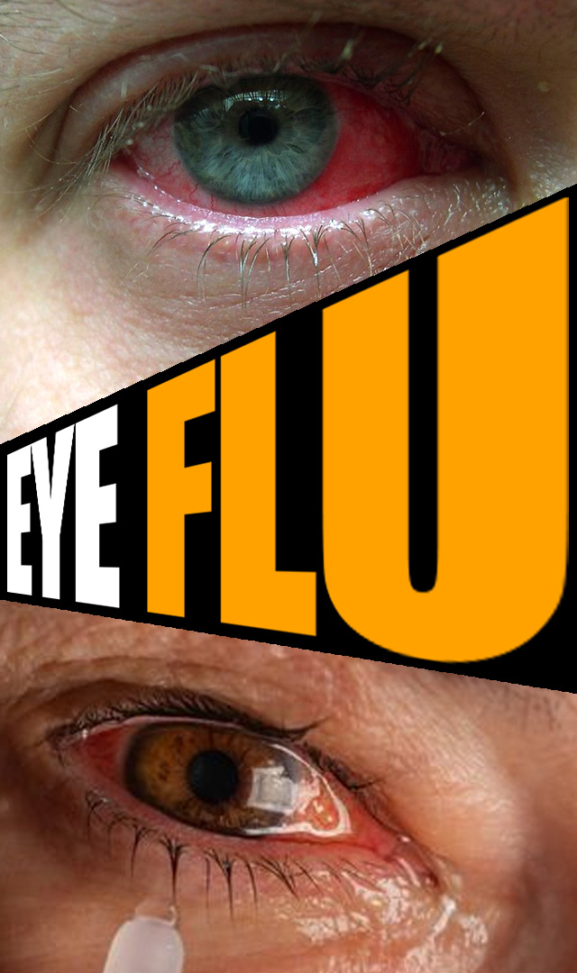 आई फ्लू कंजक्टिवाइटिस से बचने के 6 उपाय