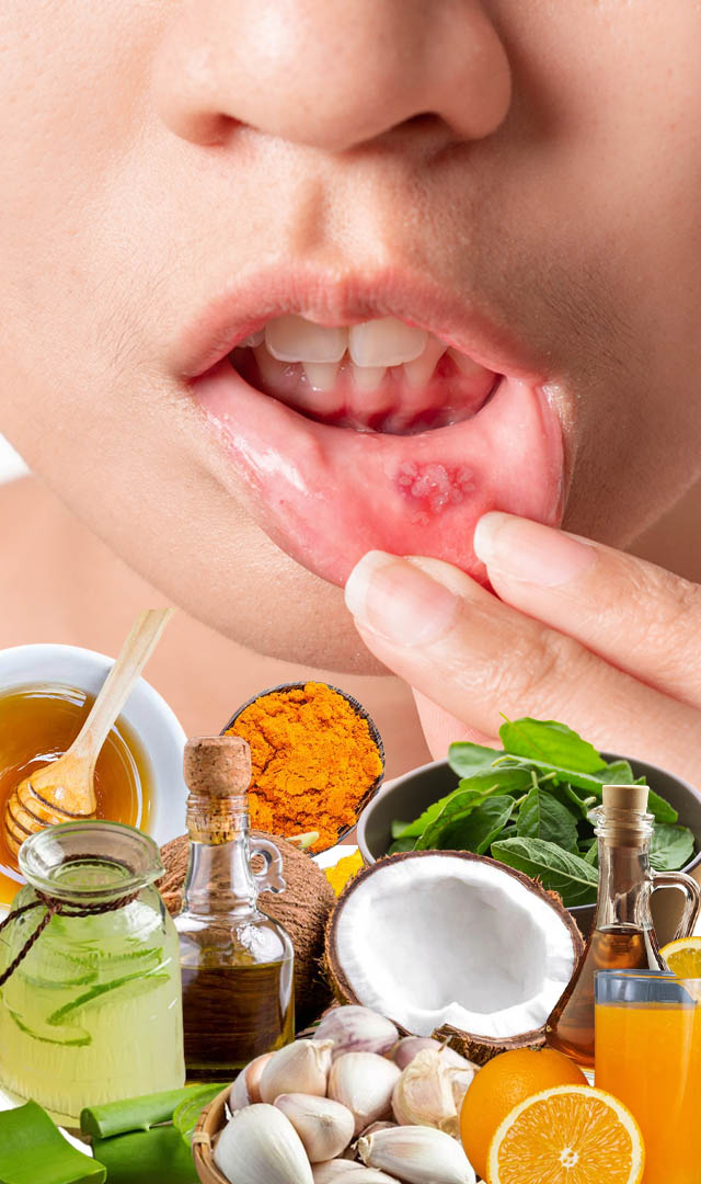 मुंह में छालों से राहत के लिए इन घरेलू उपाय को करें