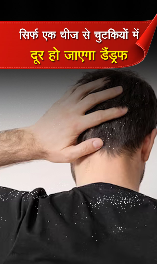 सिर्फ एक चीज से चुटकियों में दूर हो जाएगा डैंड्रफ