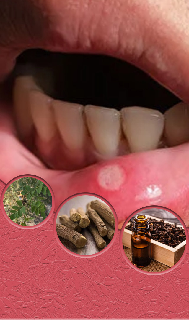 मुंह के छाले इन टिप्स से तुरंत होंगे दूर