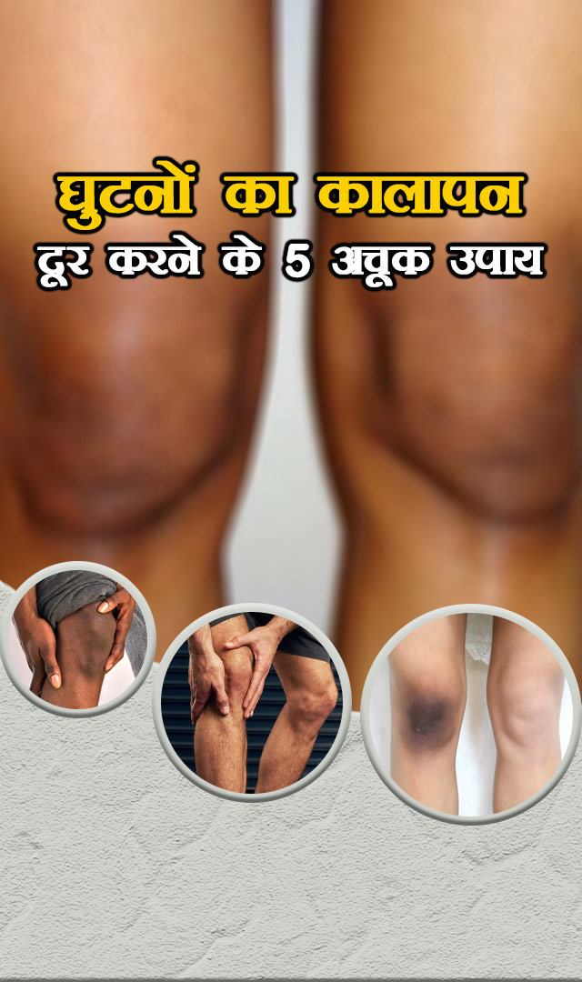 घुटनों का कालापन दूर करने के 5 अचूक उपाय