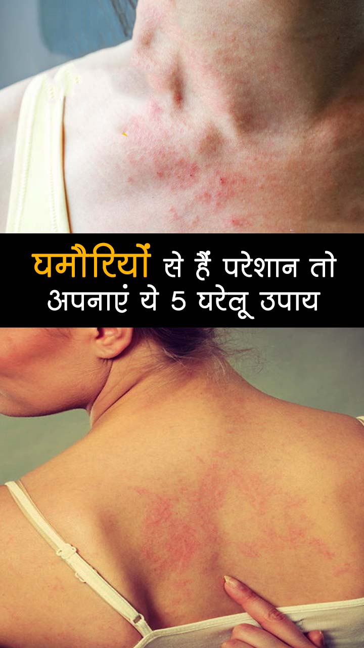 घमौरियों से हैं परेशान तो अपनाएं ये 5 घरेलू उपाय