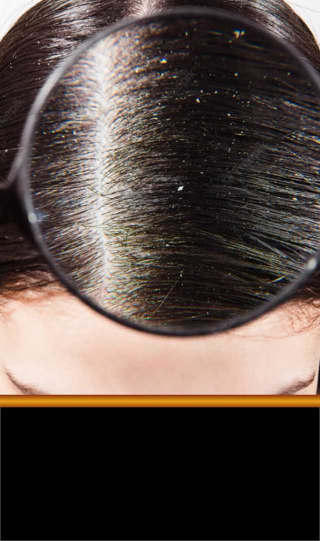 ಕಾಂತಿಯುತ ಕೇಶ ಪಡೆಯಲು ತಲೆಹೊಟ್ಟು ನಿವಾರಣೆಗೆ ಮನೆಯಲ್ಲಿಯೇ ಇದೆ ಸರಳ ಮದ್ದು