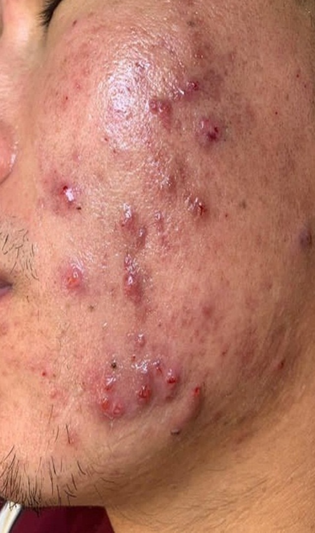 ಮೊಡವೆಗೆ ಶಾಶ್ವತ ಪರಿಹಾರ ಇಲ್ಲಿದೆ