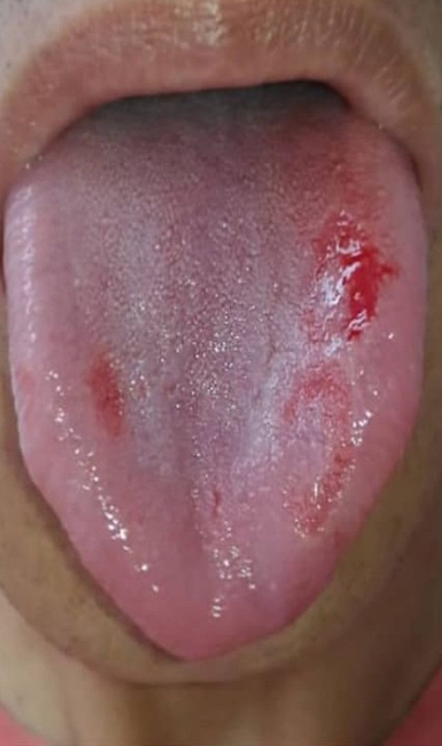 Home remedy to ease tongue burn