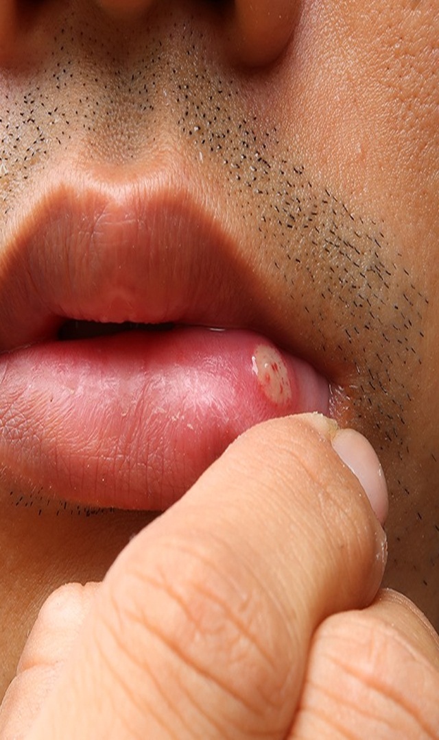 ಬಾಯಿ ಹುಣ್ಣಿಗೆ ಸರಳ ಪರಿಹಾರ