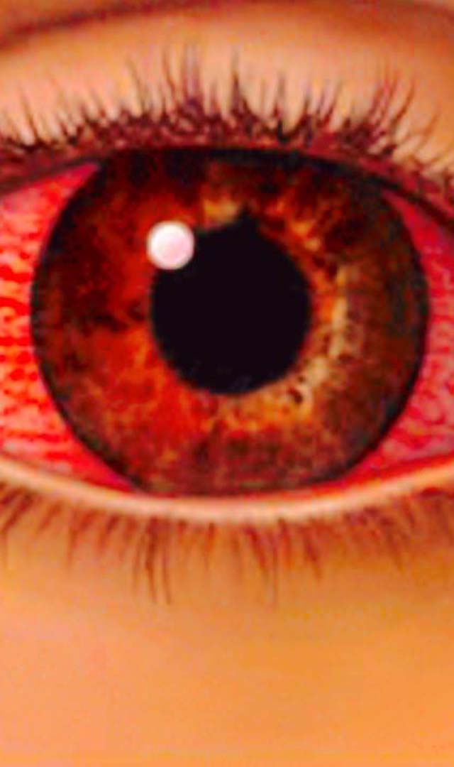 ಮದ್ರಾಸ್ ಐ ಅಥವಾ ಕೆಂಪು ಕಣ್ಣಿನ ಲಕ್ಷಣಗಳು ಮತ್ತು ಚಿಕಿತ್ಸೆ