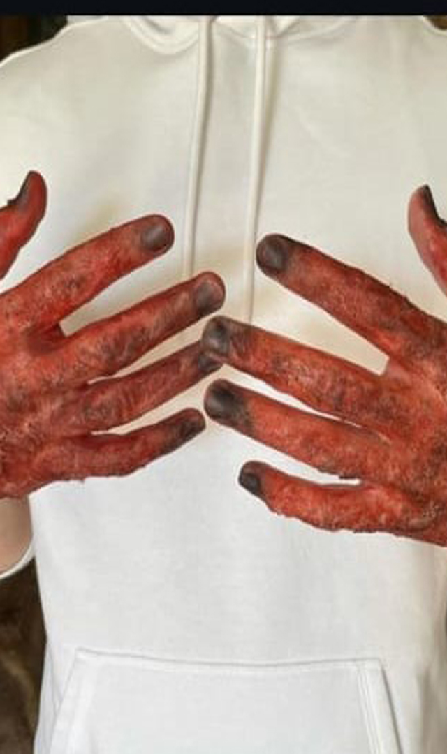 ಬಿಸಿ ನೀರು ಮೈಗೆ ಬಿದ್ದರೆ ಏನು ಮಾಡಬೇಕು