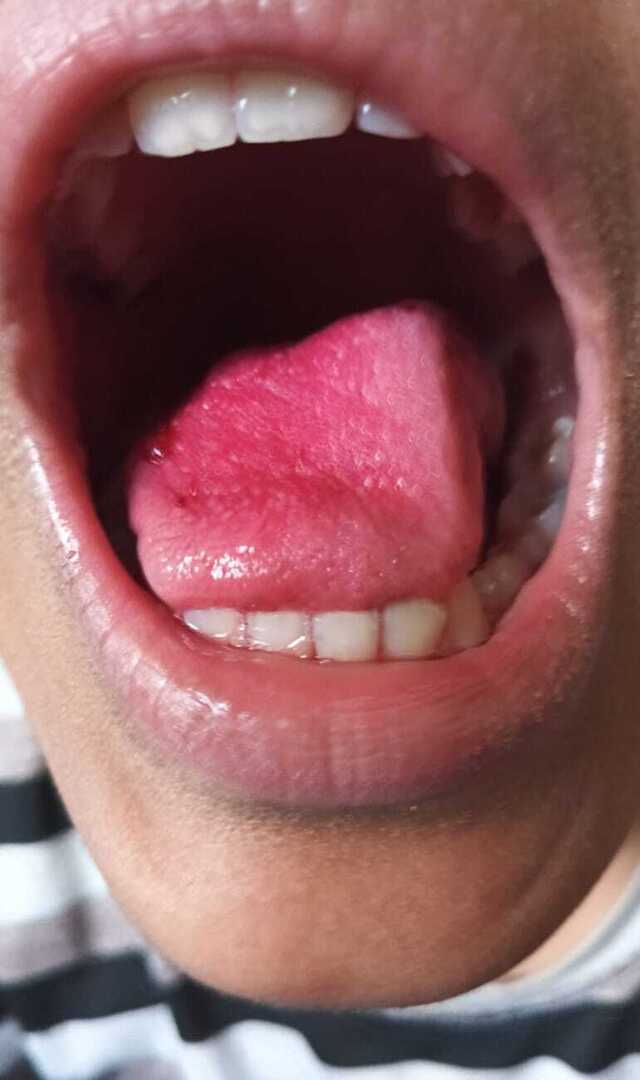 ಬಾಯಿಯೊಳಗೆ ಗಾಯವಾದರೆ ಏನು ಮಾಡಬೇಕು