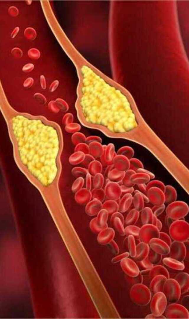 ತೆಳ್ಳಗಿದ್ದವರಿಗೆ ಕೊಲೆಸ್ಟ್ರಾಲ್ ಹೆಚ್ಚಾಗಲ್ವಾ
