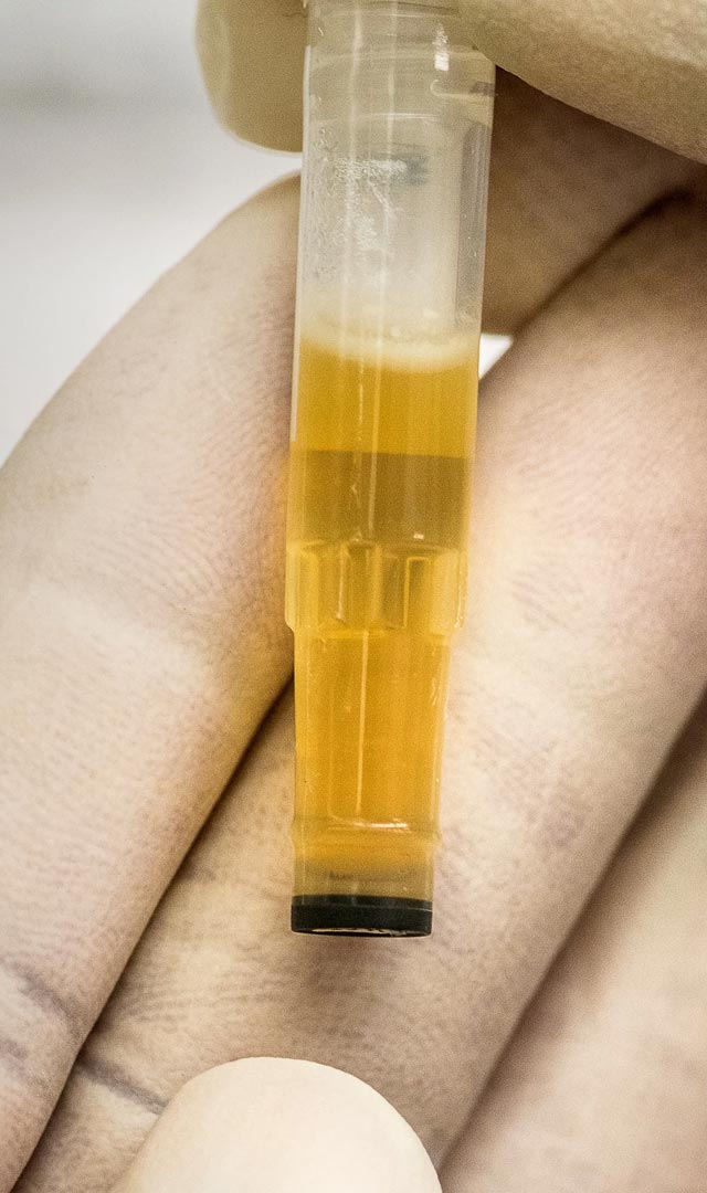 Uric acid कमी करण्यासाठी 1 घरगुती उपाय