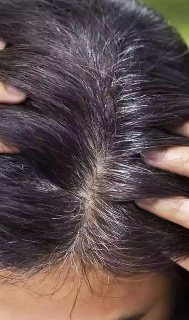 पांढर्‍या केसांच्या समस्येवर घरगुती उपाय 
