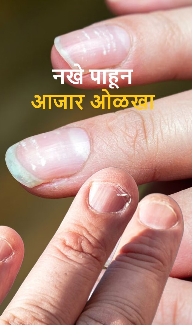 नखे पाहून आजार ओळखा
