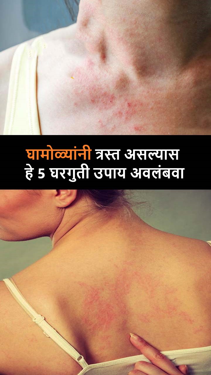 घामोळ्यांनी त्रस्त असल्यास हे 5 घरगुती उपाय अवलंबवा 