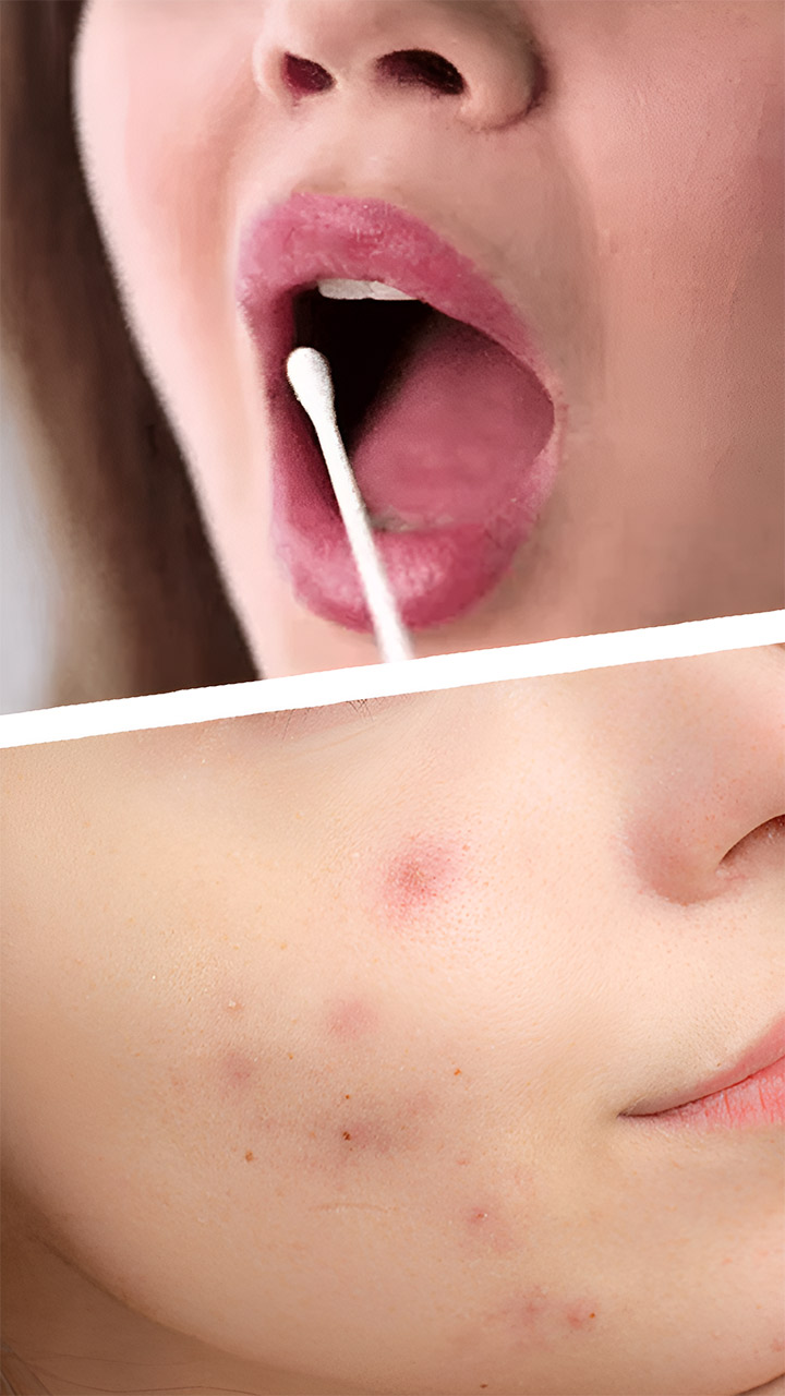 थूंक लावल्याने खरोखरच मुरुमे दूर होतात का?