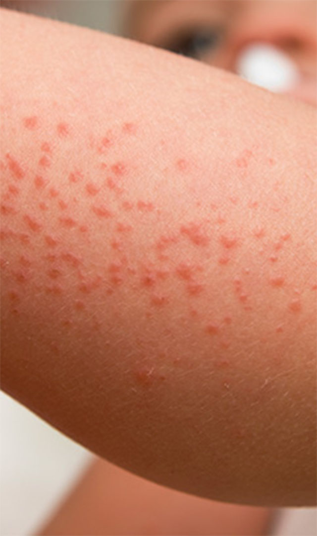 வேர்க்குருவை போக்க எளிய வீட்டு வைத்தியம்!