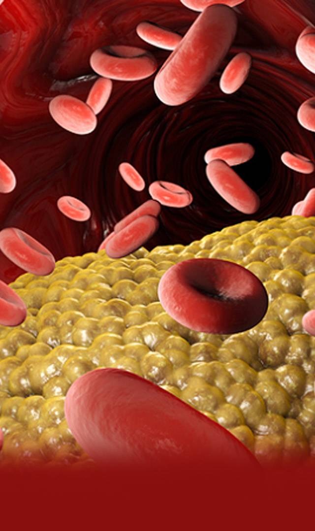 శరీరంలో చెడు కొలెస్ట్రాల్ నిరోధించే మార్గాలు ఇవే