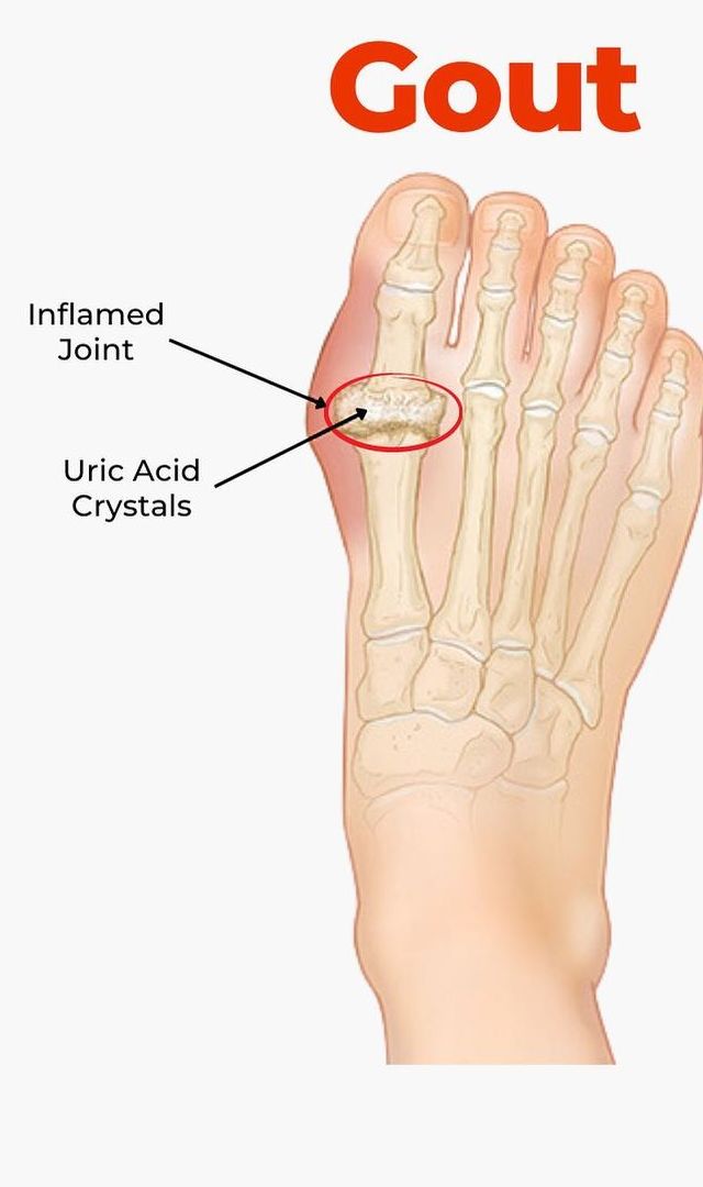 యూరిక్ యాసిడ్ పెరుగుతోందని తెలుసుకునేది ఎలా?