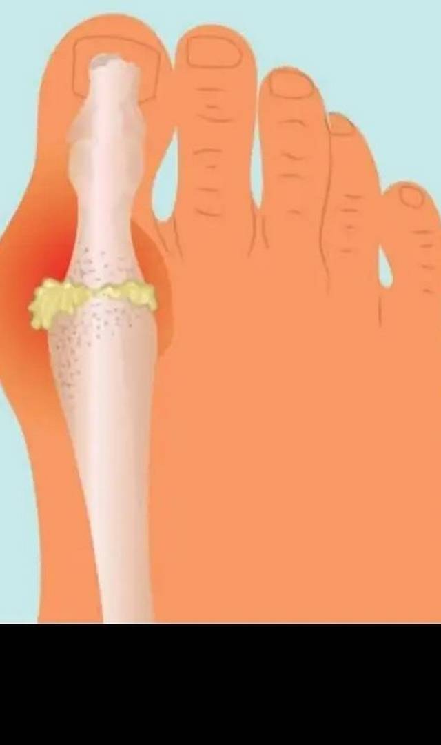 ఈ 7 పదార్థాలు శరీరంలో యూరిక్ యాసిడ్‌ని పెంచుతాయి, ఏంటవి?